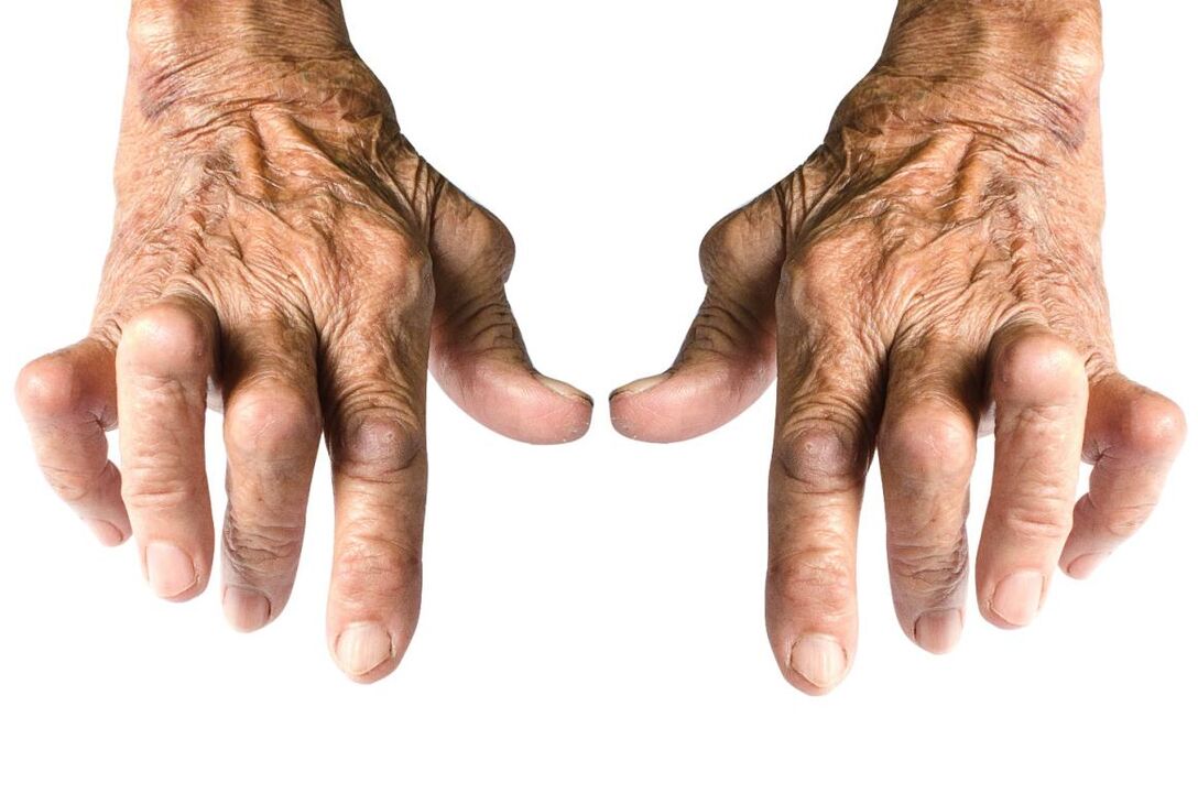 Symptoms of arthritis - joint deformity