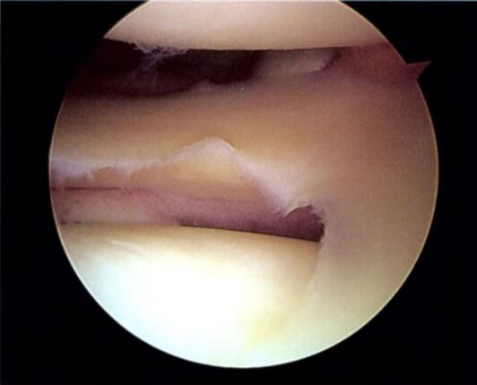 Herniated meniscus causing osteoarthritis of the knee