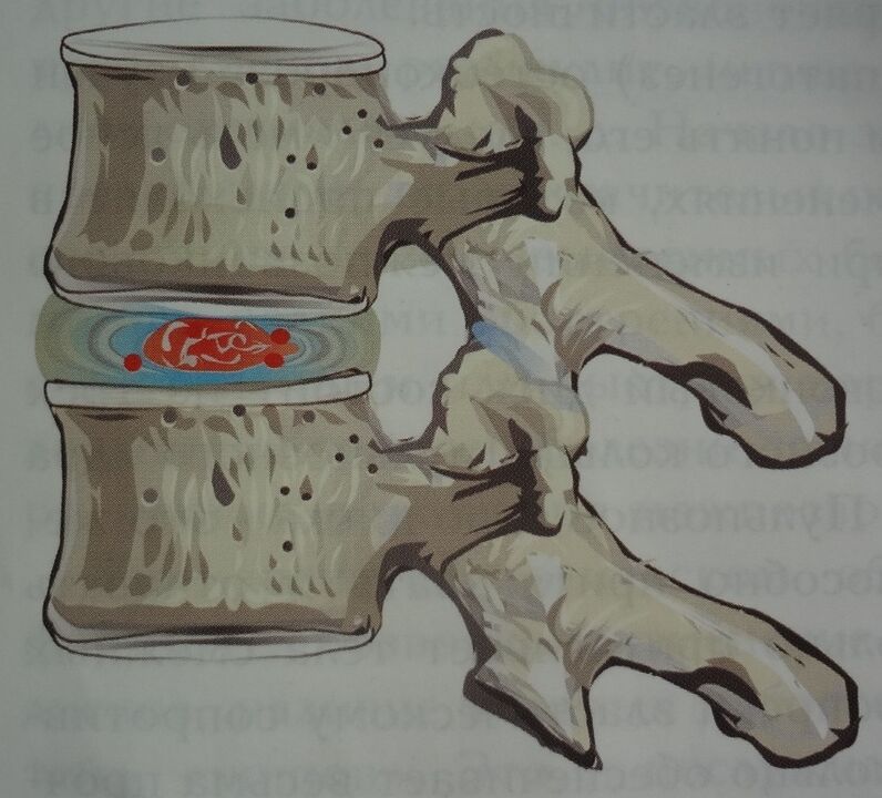 Damage to the nuclear pulp of the intervertebral disc in the first stage of cervical osteochondrosis