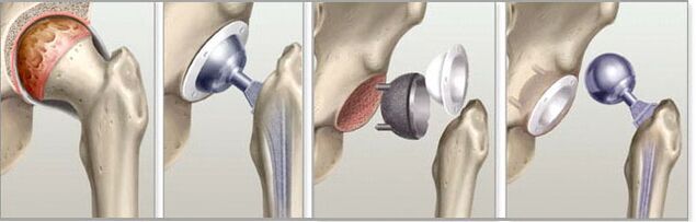 hip-pelvic arthroplasty for osteoarthritis