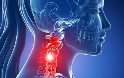 Osteocondrosis of the neck