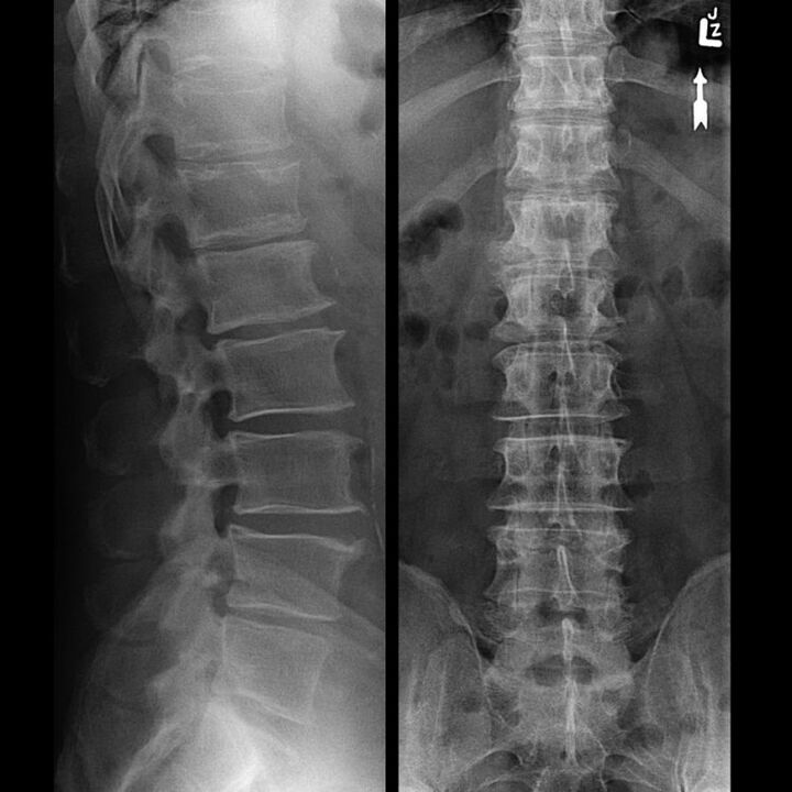 Sning with the osteocondrosis of the spine
