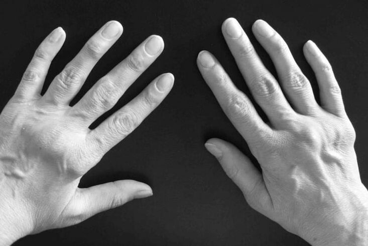 Arthritis symptoms in the joints of hands