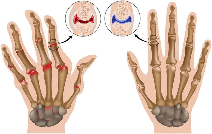 Damaged healthy hand combinations and joints damaged by Artrosis