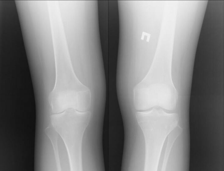 X-rays affected by Arthosis