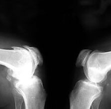 X-ray arthrosis