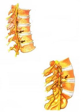 description of spinal osteochondrosis